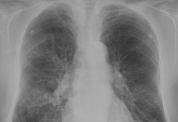 COPD uit basisverzekering vanaf 2019